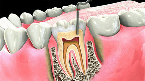 All you need to know about a root canal