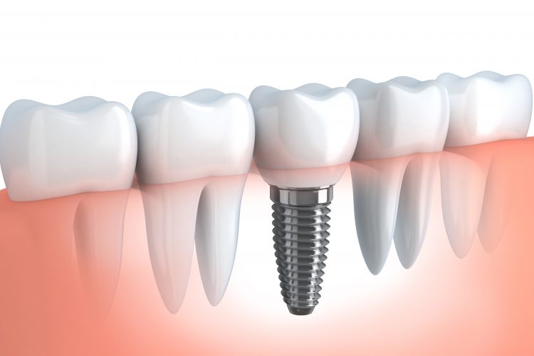 Picture of a fitted permanent dental implant