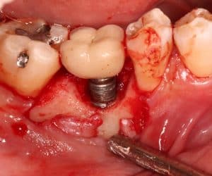 Peri-implantitis inflammation around dental implant