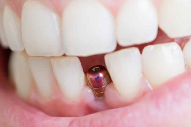 Dental implant treatment