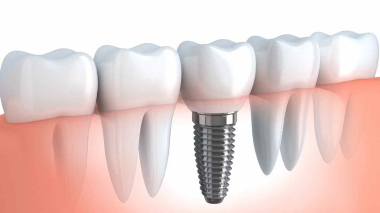 Picture of a fitted permanent dental implant