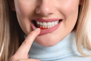 Showing signs of periodontal disease