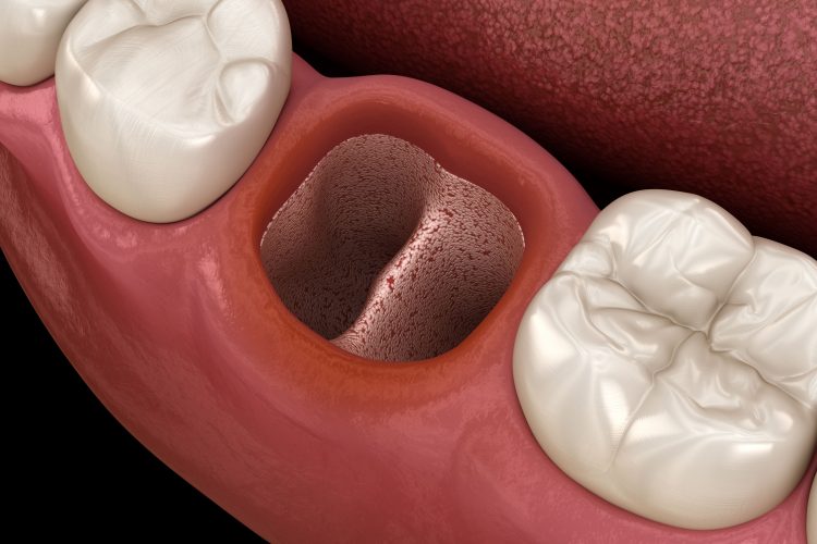 an image of tooth loss