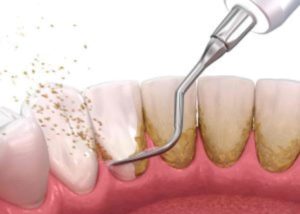 An image of scraping dental plaque