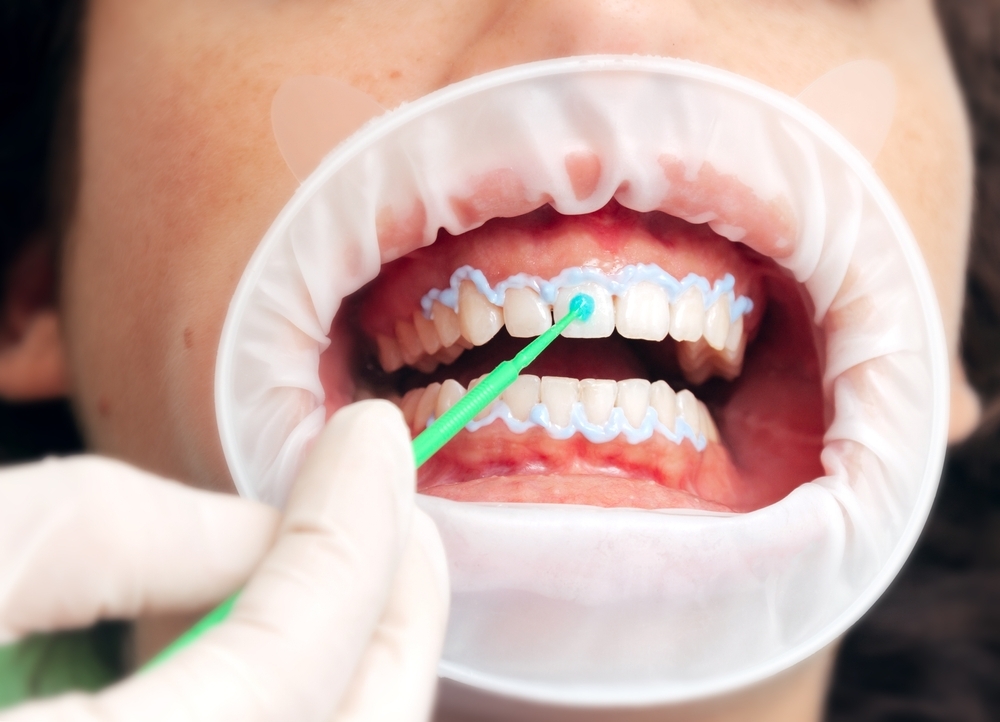 How To Whiten Teeth with Hydrogen Peroxide?