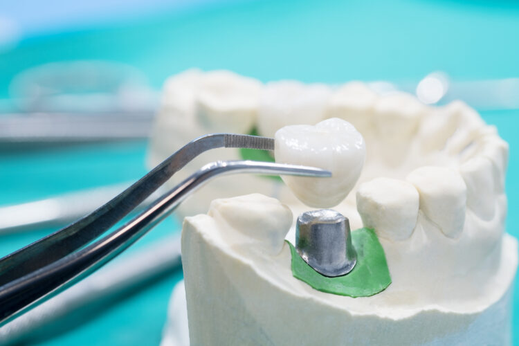 What are dental crowns