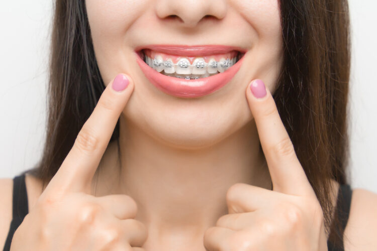 Everything you need to know about dental braces