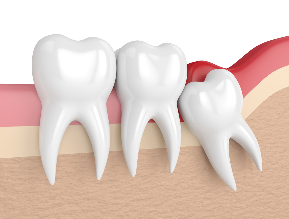pericoronitis